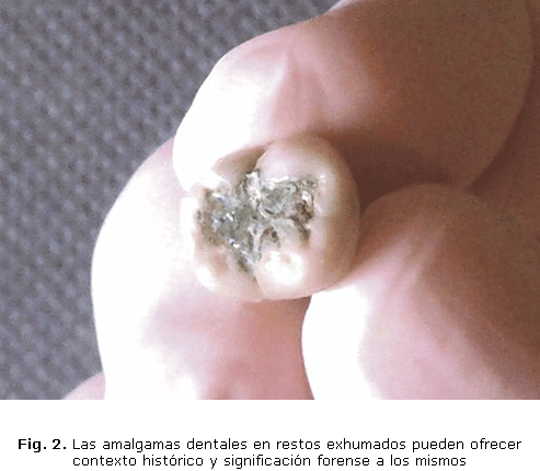 Fig. 2. Las amalgamas dentales en restos exhumados pueden ofrecer contexto histórico y significación forense a los mismos