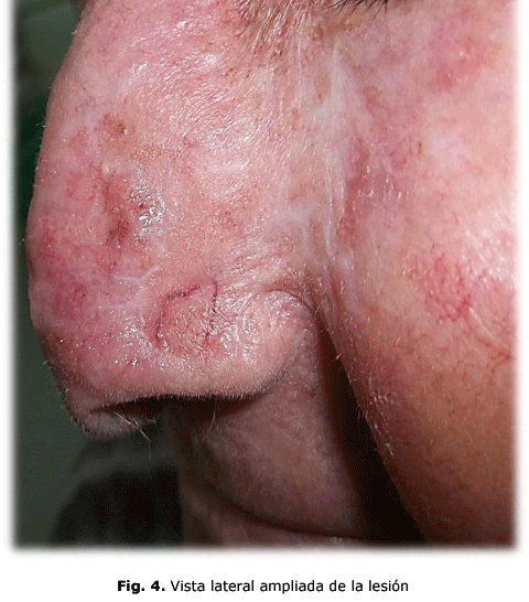 Fig. 4. Vista lateral ampliada de la lesión