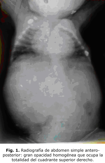 Fig. 1. Radiografía de abdomen simple antero-posterior: gran opacidad homogénea que ocupa la totalidad del cuadrante superior derecho
