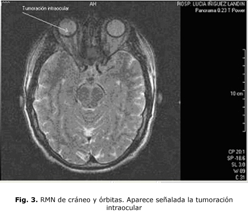 Fig. 3. RMN de cráneo y órbitas. Aparece señalada la tumoración intraocular