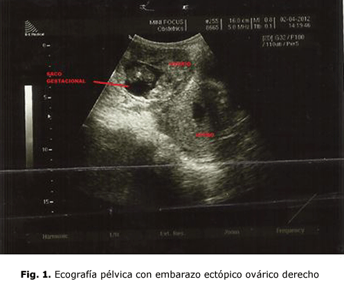 Fig. 1. Ecografía pélvica con embarazo ectópico ovárico derecho