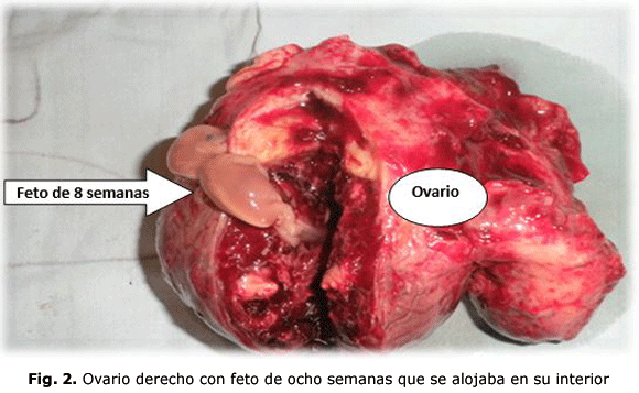 Fig. 2. Ovario derecho con feto de ocho semanas que se alojaba en su interior
