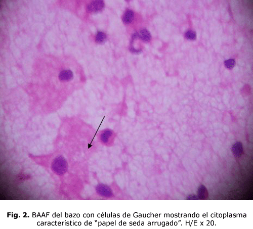 Células espumosas en aspirado de médula ósea en un paciente con