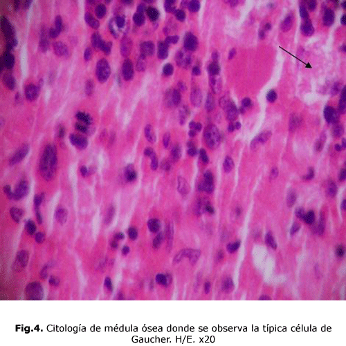 Fig.4. Citología de médula ósea donde se observa la típica célula de Gaucher. H/E. x20