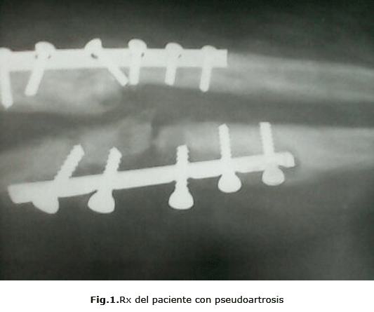 Fig.1.Rx del paciente con pseudoartrosis