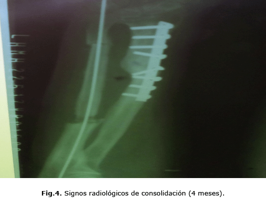 Fig.4. Signos radiológicos de consolidación (4 meses).