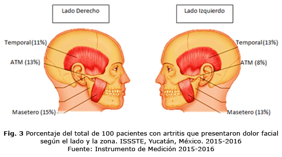 Fig. 3 Porcentaje del total de 100 pacientes con artritis que presentaron dolor facial según el lado y la zona. ISSSTE, Yucatán, México. 2015-2016