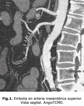 Fig.1. Embolia en arteria mesentérica superior. 