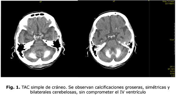 Fig. 1. TAC simple de cráneo. Se observan calcificaciones groseras, simétricas y bilaterales cerebelosas, sin comprometer el IV ventrículo