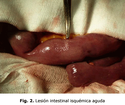 Fig. 2. Lesión intestinal isquémica aguda.