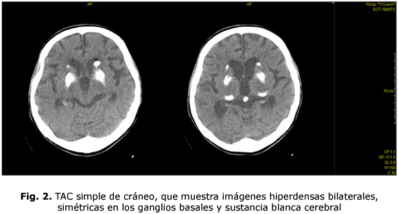 Fig. 2. TAC simple de cráneo, que muestra imágenes hiperdensas bilaterales, simétricas en los ganglios basales y sustancia blanca cerebral