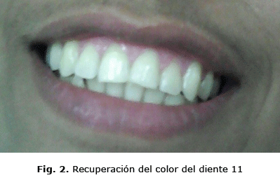 Fig. 2. Recuperación del color del diente 11
