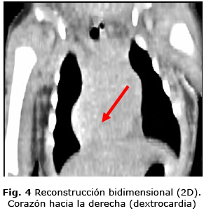Fig. 4 Reconstrucción bidimensional (2D). Corazón hacia la derecha (dextrocardia)