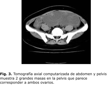 Resultado de imagen para CAUSA TUMOR DE OVARIO tomografia computarizada