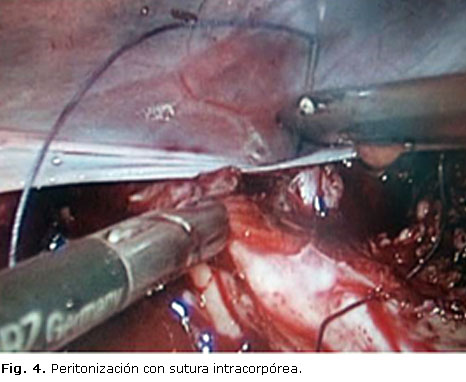 Ooforectomía O Retiro Quirúrgico Del Concepto Del Ovario O De Los