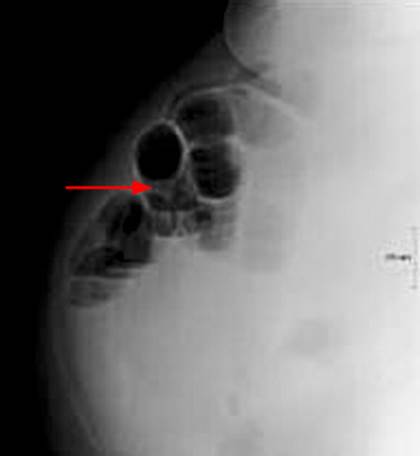 Oclusi N Intestinal Mec Nica Secundaria A Hernia De Littr