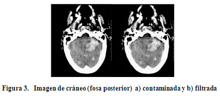 Reducción del ruido en imágenes de tomografía computarizada usando un filtro  bilateral anisotrópico