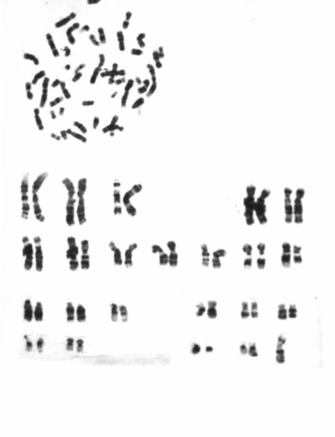 Paciente portador del síndrome de Klinefelter con fórmula cromosómica 47XXY.