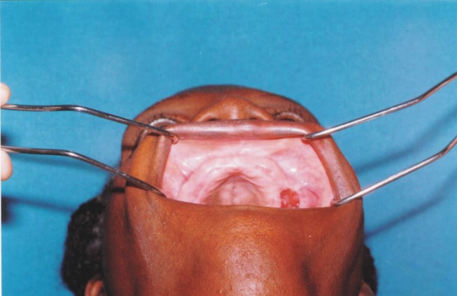 papiloma tabique nasal