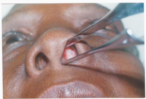 Oxiuros nariz, Papiloma nasal histologia