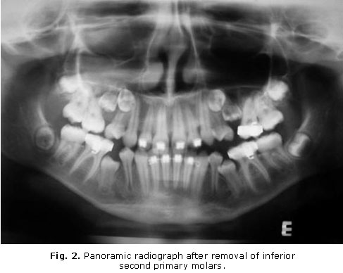 Second Molar Extraction