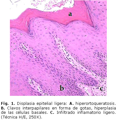 cancer bucal histologia