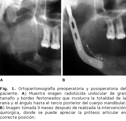 Modelo de maxilar y mandíbula afectada por un pecoma_01 - AJL