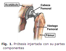 Fig. 1. Prótesis injertada con su partes componentes 
