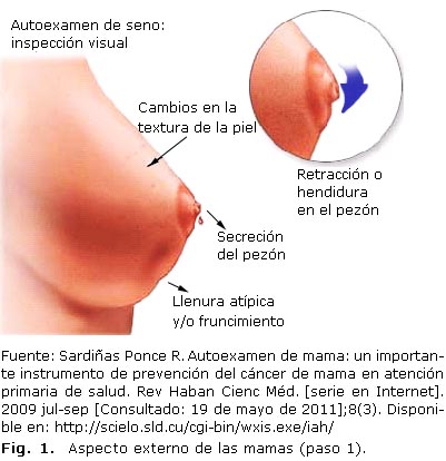 papiloma intraductal en senos)