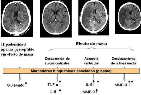 accidente cerebrovascular isquémico vs hemorrágico resonancia magnética