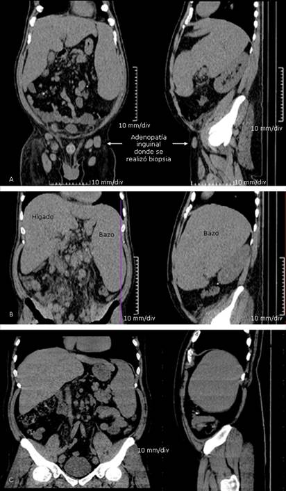 Hepatoesplenomegalia masiva en un paciente con enfermedad de