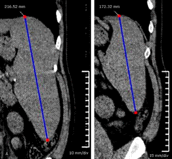 Hepatoesplenomegalia masiva en un paciente con enfermedad de