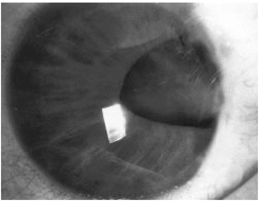 FIG. 1. Preoperatorio de catarata traumática por herida perforante ocular con iridectomía en