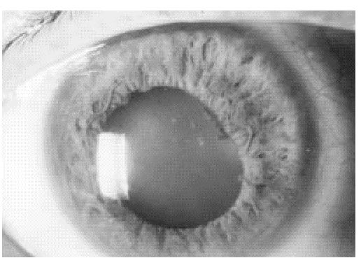 FIG. 3. Preoperatorio de catarata posuveítica, observe deformidad pupilar aún en midriasis por