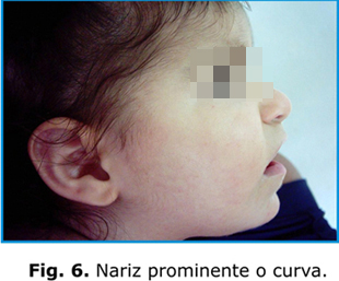 SciELO - Brasil - Síndrome de Rubinstein-Taybi: anomalias físicas,  manifestações clínicas e avaliação auditiva Síndrome de Rubinstein-Taybi:  anomalias físicas, manifestações clínicas e avaliação auditiva