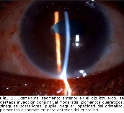 cisticerco de la tenia solium