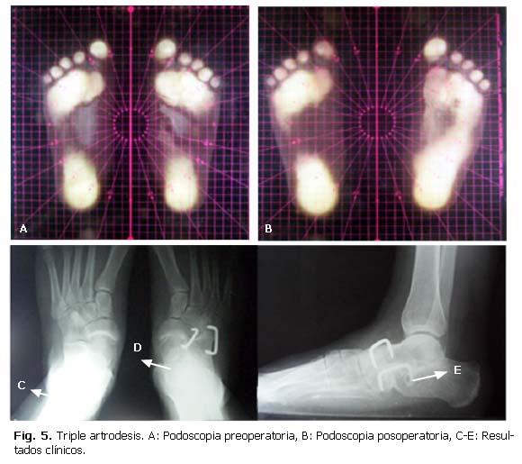 A lábkezelő gyógyszerek deformáló artrózisa. Deformálódik a kezek arthrosisának kezelése