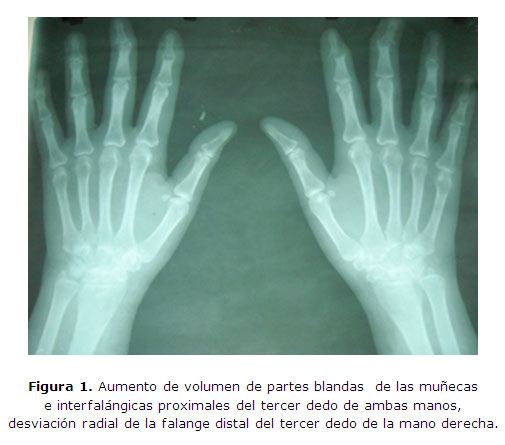 Artrosis en la mano - ScienceDirect