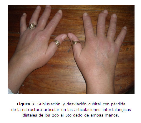 Cirugía de Rodilla por Artrosis - Dr. J. Galindo Contreras