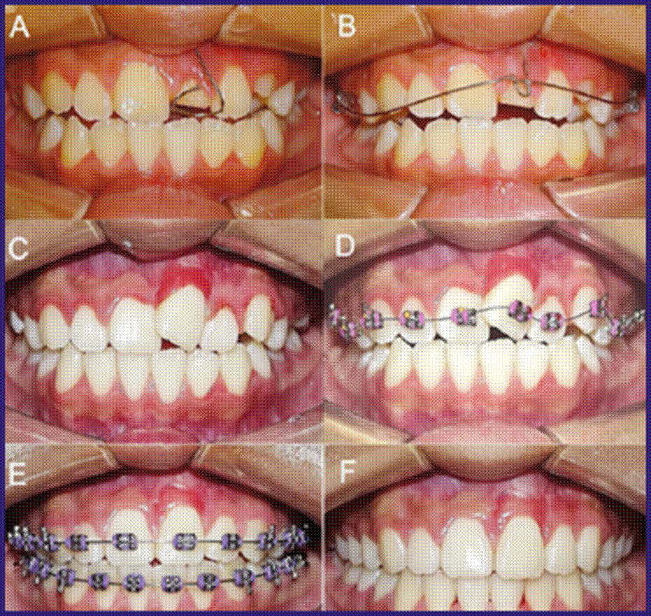 El uso de un cantiléver para el tratamiento ortodóncico del incisivo