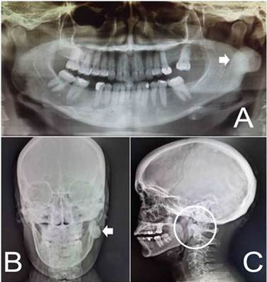 Osteoma de mandíbula: relato de caso