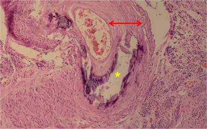 oficial Suavemente mordaz Arterioesclerosis de Monckeberg en vasos uterinos: un interesante hallazgo  incidental