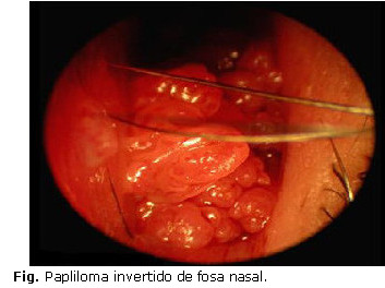 papiloma nasal tipos