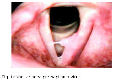 Que es la enfermedad papilomatosis Papilomatosis en la piel - rafinament-club.ro