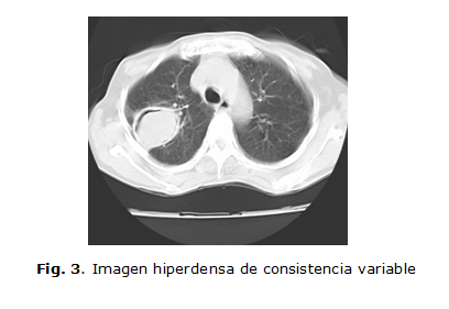 Prueba cutánea de antígeno de Aspergillus MedlinePlus enciclopedia médica  illustración