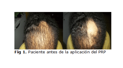 Bioestimulación capilar rico en plaquetas contra caída del cabello