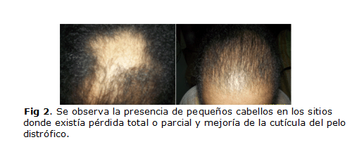 Bioestimulación capilar rico en plaquetas contra caída del cabello